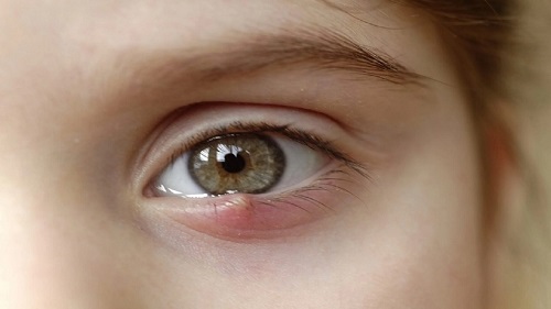 بیماری عفونی چشمی