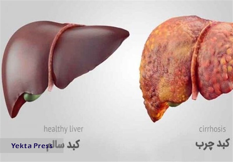فرضیه‌ای جدید:آیا مصرف زیاد آب منجر به کبدچرب می‌شود؟